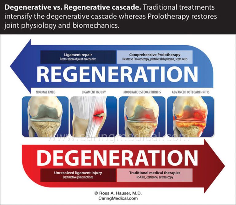 Prolotherapy The Regenerative Treatment for Arthritic Joints