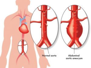 Abdominal Aortic Aneurysm: Are You at Risk?
