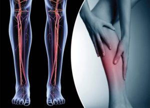 DVTs & Leg Swelling:  What You Need to Know