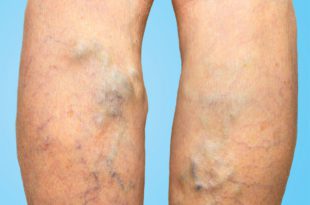 Did You Know That Men Can Get Varicose Veins Too?