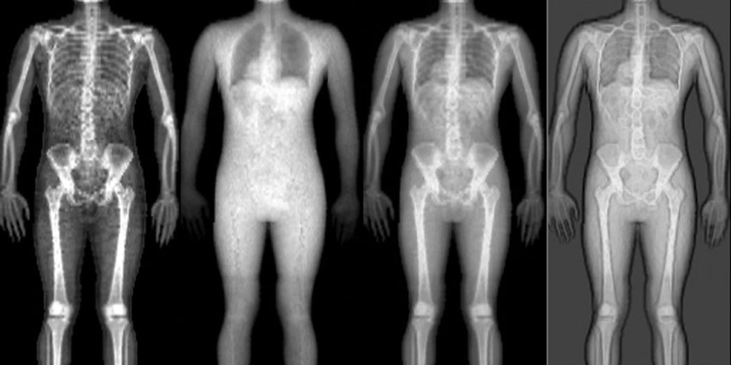 Do you Have Bone Loss? Find Out How You Can Rebuild Bone Density