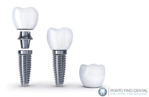 Implant Dentistry can give you a new smile