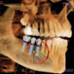 Computer Guided – Dental Implant Placement