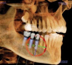 Computer Guided – Dental Implant Placement