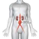 Abdominal Aortic Aneurysm