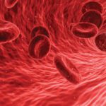 Sickle Cell Anemia