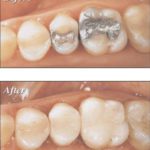 All in one Dental Visit with CEREC