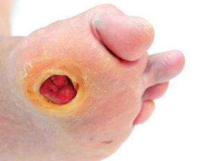 Diabetic Wound Healing: Why is it so Challenging to Treat?