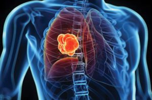 Lung Cancer Awareness Month:  Low Dose CT Screenings Save Lives