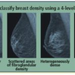 What you should know about dense breast