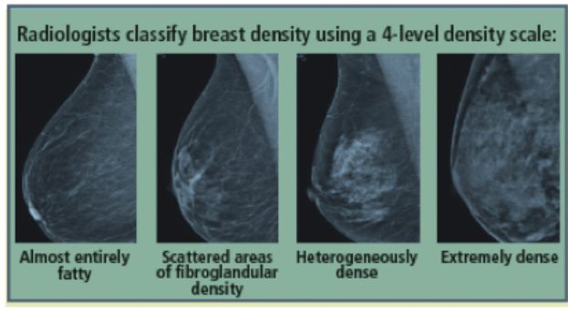 What you should know about dense breast