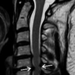 Cervical Myelopathy