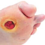 Diabetic Wound Healing