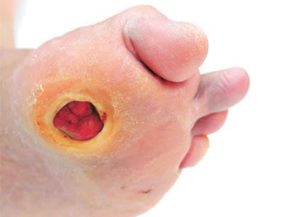Diabetic Wound Healing