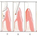 LASER Gum Disease Treatment – The alternative to Surgery