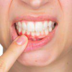 Periodontal Disease and Bone Loss