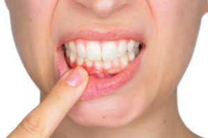 Periodontal Disease and Bone Loss