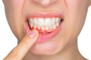 Periodontal Disease and Bone Loss: Bone Grafting and Implants Offer Multiple Benefits