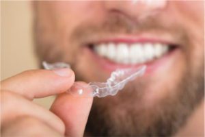 Teeth Straightening Without Braces with SureSmile Aligners 