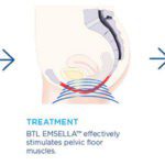 After Childbirth Many Women Have a Weakened Pelvic Floor & Urinary Incontinence: