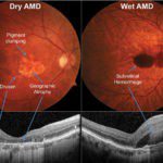 Diagnosing Macular Degeneration Early is Critical to Saving Sight