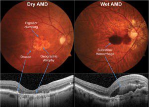 Diagnosing Macular Degeneration  Early is Critical to Saving Sight