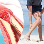 Many People Ignore the Symptoms of Peripheral Arterial Disease, Which Can Be FATAL