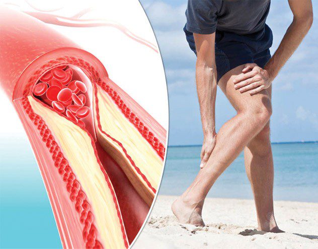 Many People Ignore the Symptoms of Peripheral Arterial Disease, Which Can Be FATAL