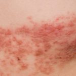 Post-Herpetic Neuralgia: Treatment After the Rash