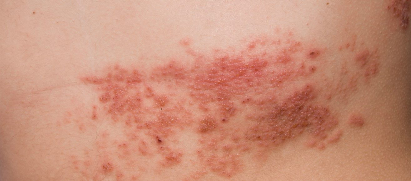 Post-Herpetic Neuralgia: Treatment After the Rash