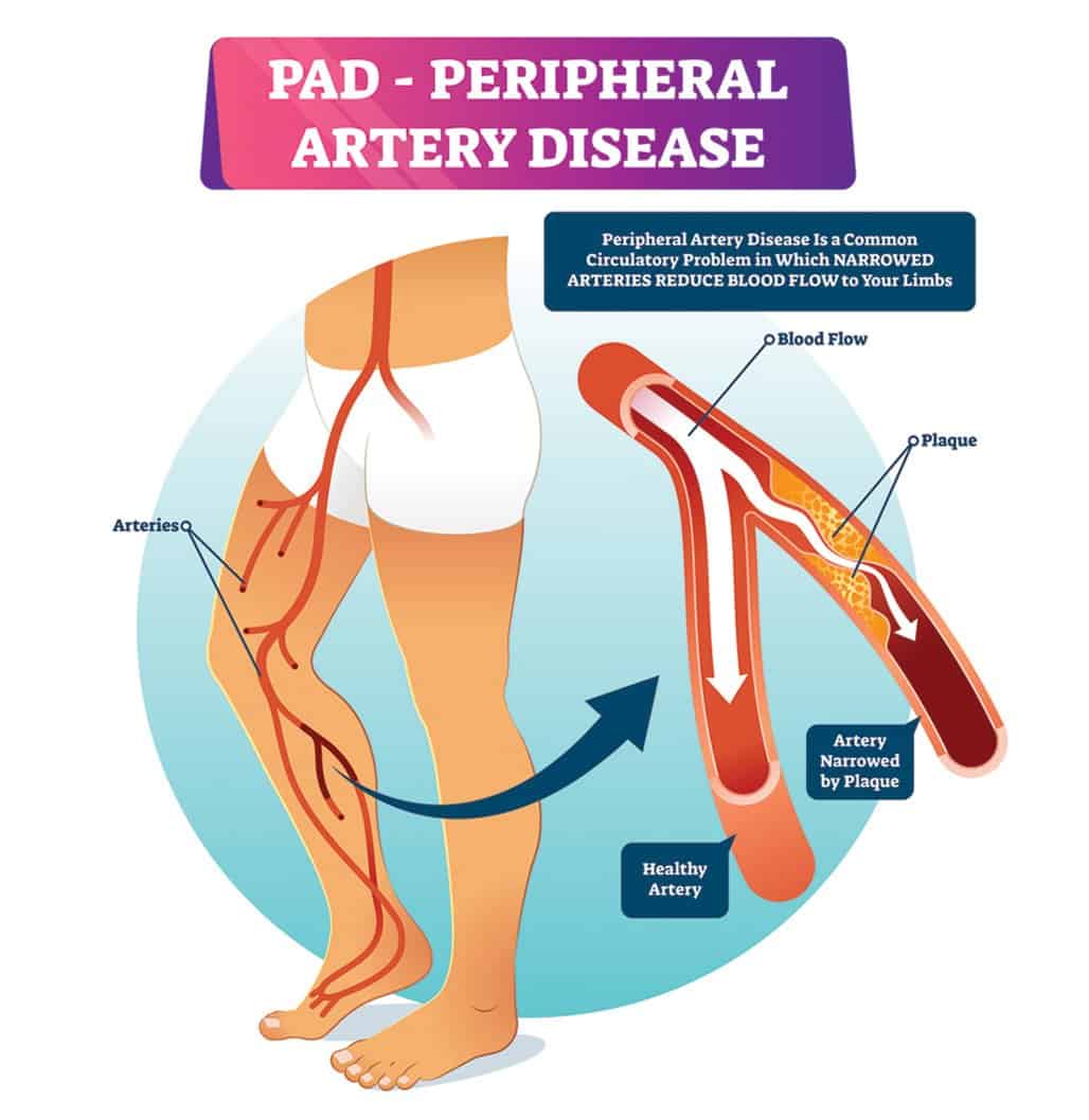 Can Peripheral Artery Disease Cause Heart Attack