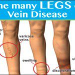 VEINS 101: 50 Million Americans Have Treatable Vein Disease!