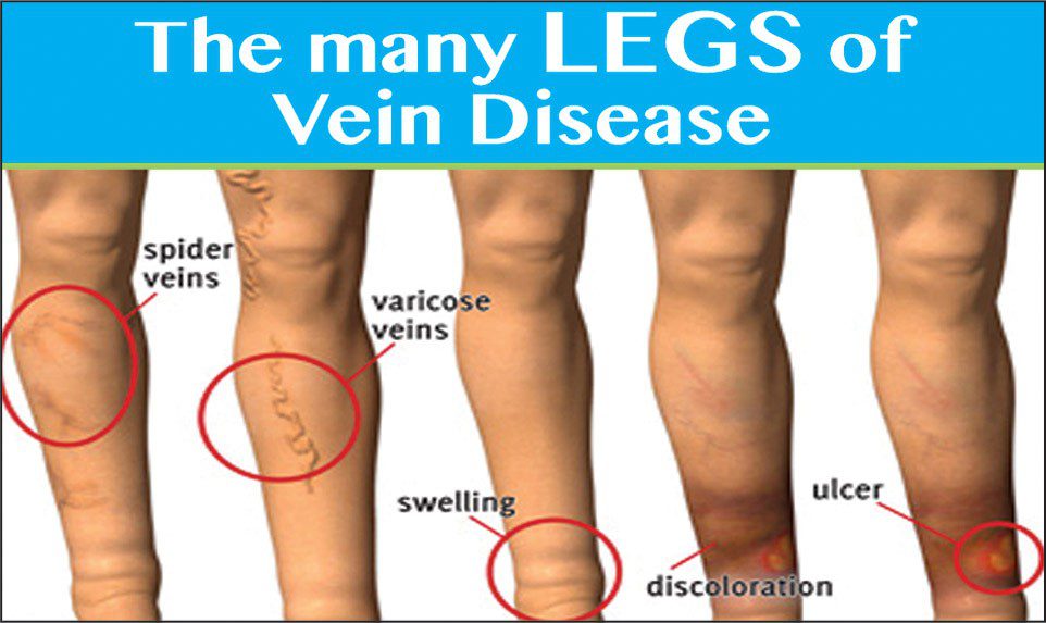 VEINS 101: 50 Million Americans Have Treatable Vein Disease!