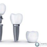 Implant Dentistry can give you a new smile