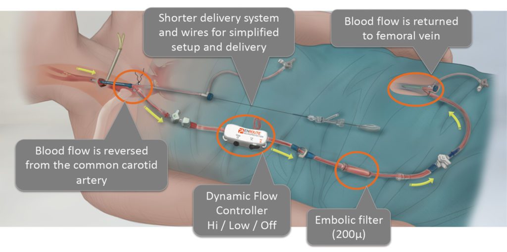 A Blocked Carotid Artery Is Critical, And The Traditional Procedure Can ...