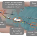 A Blocked Carotid Artery Is Critical