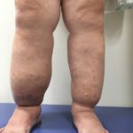 Cancer Treatment and Lymphedema