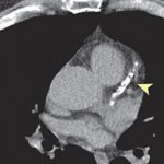 Coronary Artery Disease