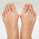 Don’t Ignore Painful, Swollen Bunions