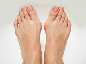 Don’t Ignore Painful, Swollen Bunions