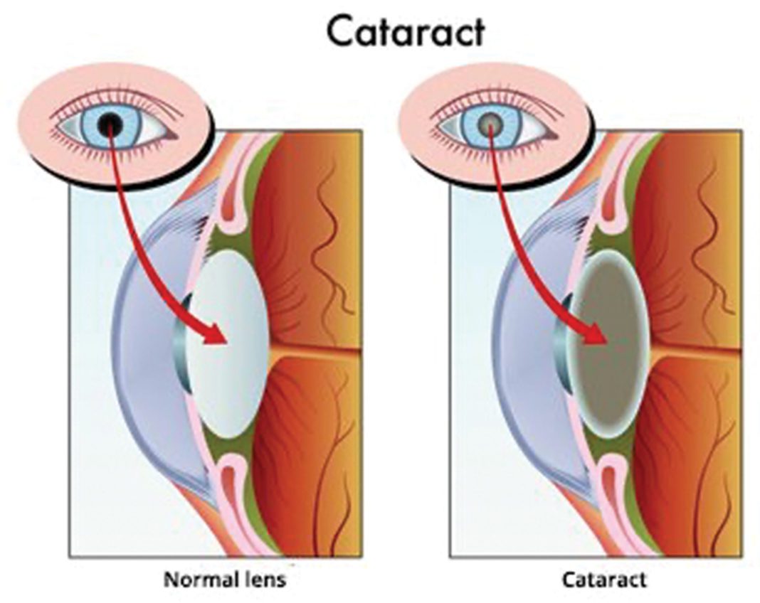 when should you get cataract surgery