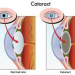 When Should You Get Cataract Surgery?