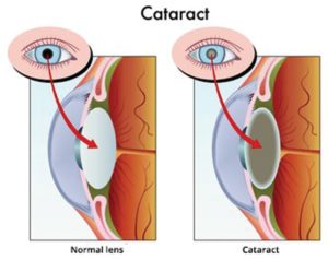When Should You Get Cataract Surgery?