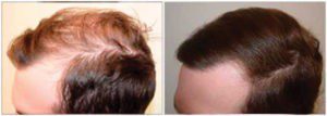 Hair Loss is an Emotional Experience!  What You Can Do