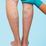 How to Prevent and Manage Varicose Veins