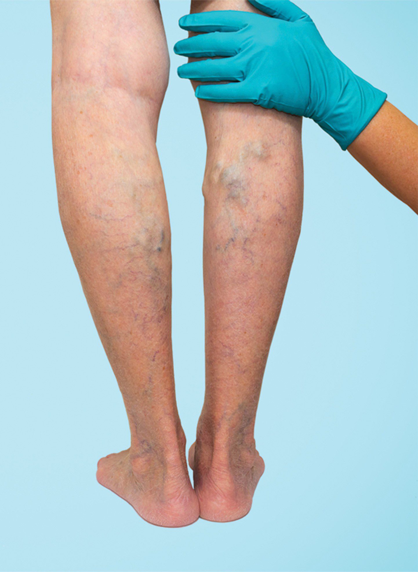 Love Your Legs: Tips for Varicose Vein Prevention