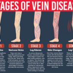 Venous Disease