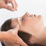 Facial Cosmetic Acupuncture