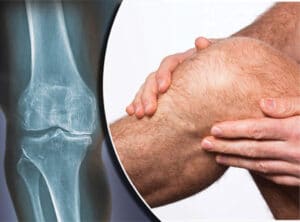 Osteoarthritis of the Knee