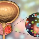 Prostate Cancer and COVID-19